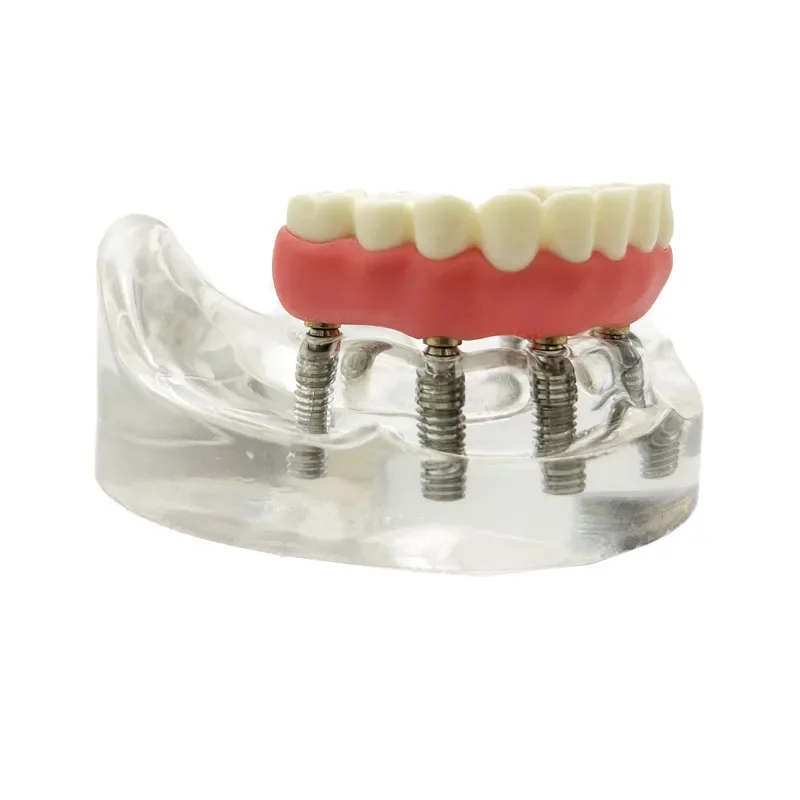 Model implantu dentystycznego z implantacją Overdenture główny dolny implant zębów wymienny model dla dentysty nauczanie i nauki Demo