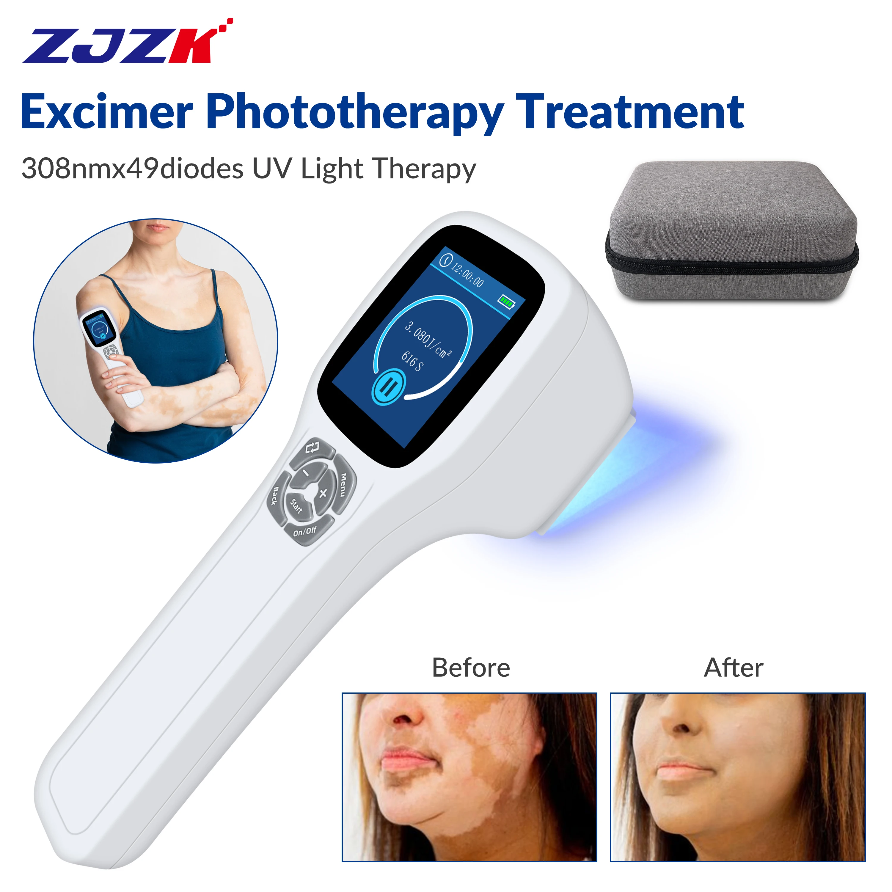 

ZJZK UV Phototherapy Light Skin Lightening Laser Treatment Cost Therapy For Body 308nmx49diodes Folliculitis Round Granuloma