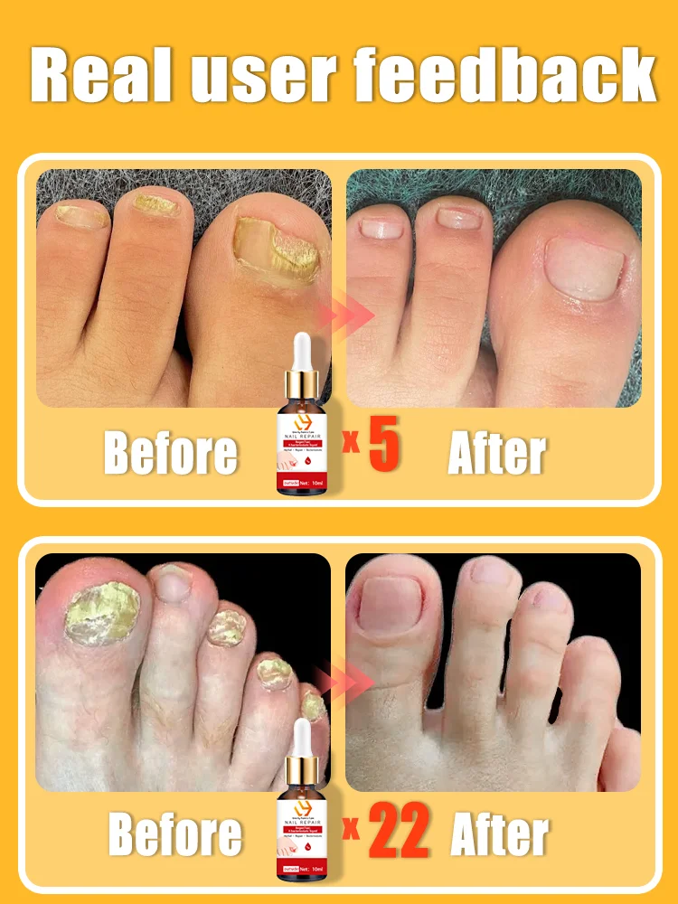 The most powerful black technology in 2024 will completely solve the problem of nail mold!