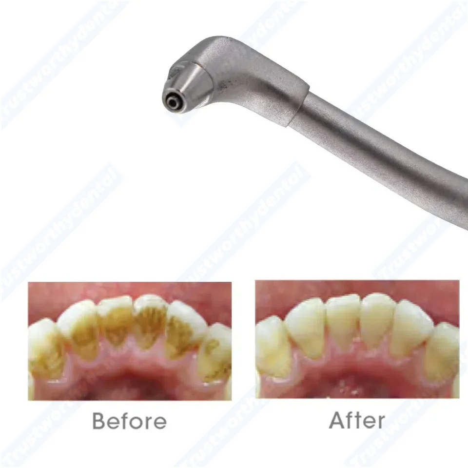 فوهة بديلة NSK Prophy Mate Neo للأسنان، طرف ملمع الهواء لنظام NEO NSK Prophy Mate 90 °    120 °   مجموعة الزوايا المتوافقة