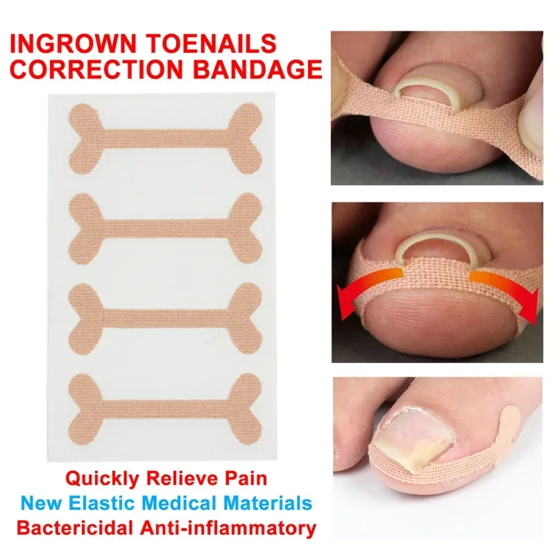 Ingrown Toenail Corrector Sticker Nail Strip Anti-roll Nail Free Glue Toe Inlay Nail Corrector Patch Correction Stickers Toenail