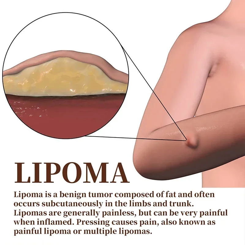 Crema calmante para eliminación de lipomas, alivio del dolor de forma segura, crema subcutánea para eliminar grumos de grasa, celulitis