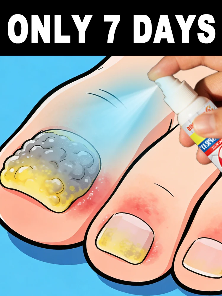 

Just spray it on and get rid of the root cause of onychomycosis! ᔆᵘᵖᵉʳ ᵉᵃˢʸ ᵃⁿᵈ ʰᵃˢˢˡᵉ⁻ᶠʳᵉᵉ!