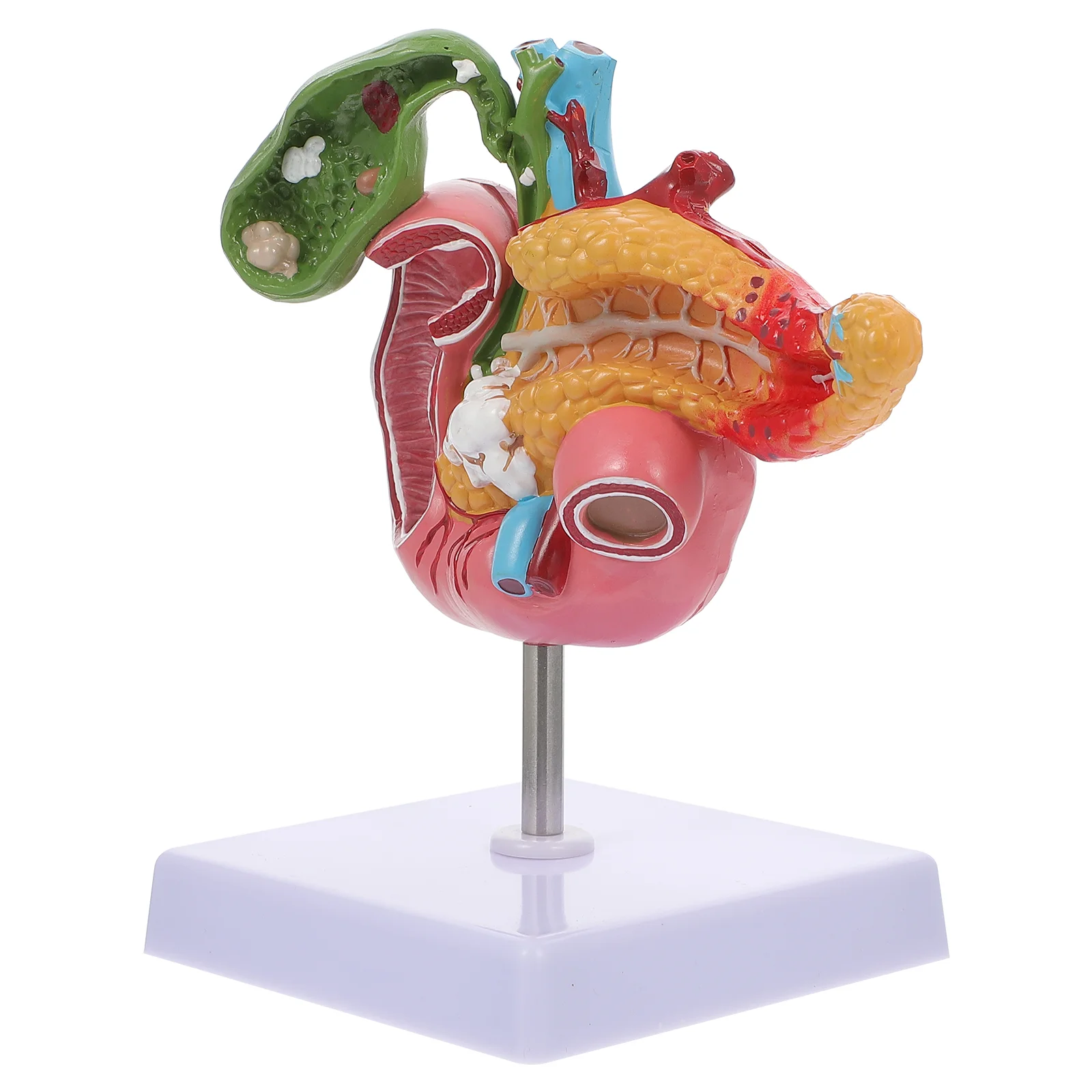 

Pancreas Pathology Model Duodenal Pathological Model Teaching Instrument for Student Study gallbladder pancreas model