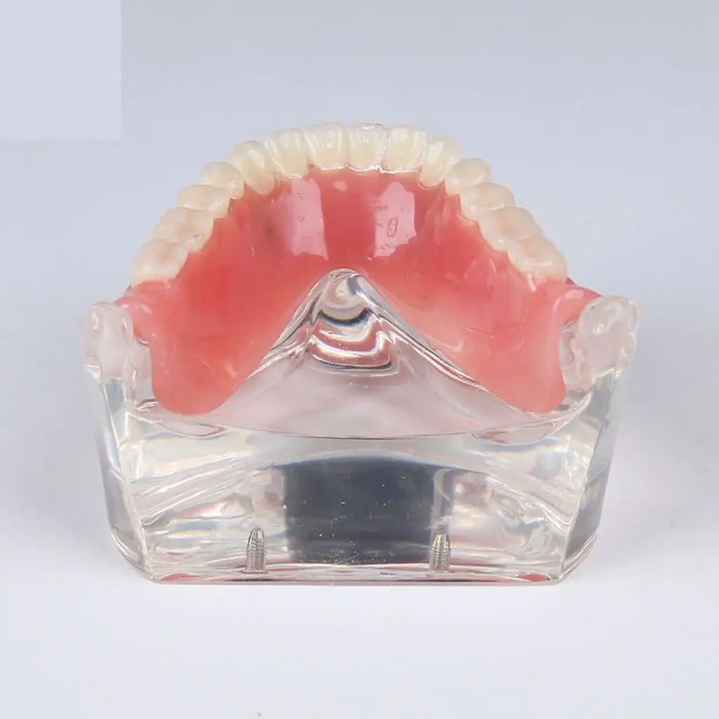 

Dental Teeth Study Teach Model Overdenture Inferior 4 Implant Demo Model