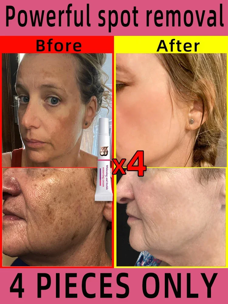 Freckles Removal Cream Remove Facial Spots Skin Dark Spot Remove Melasma Age Spots Sunspots Whitening And Freckle Removing Cream