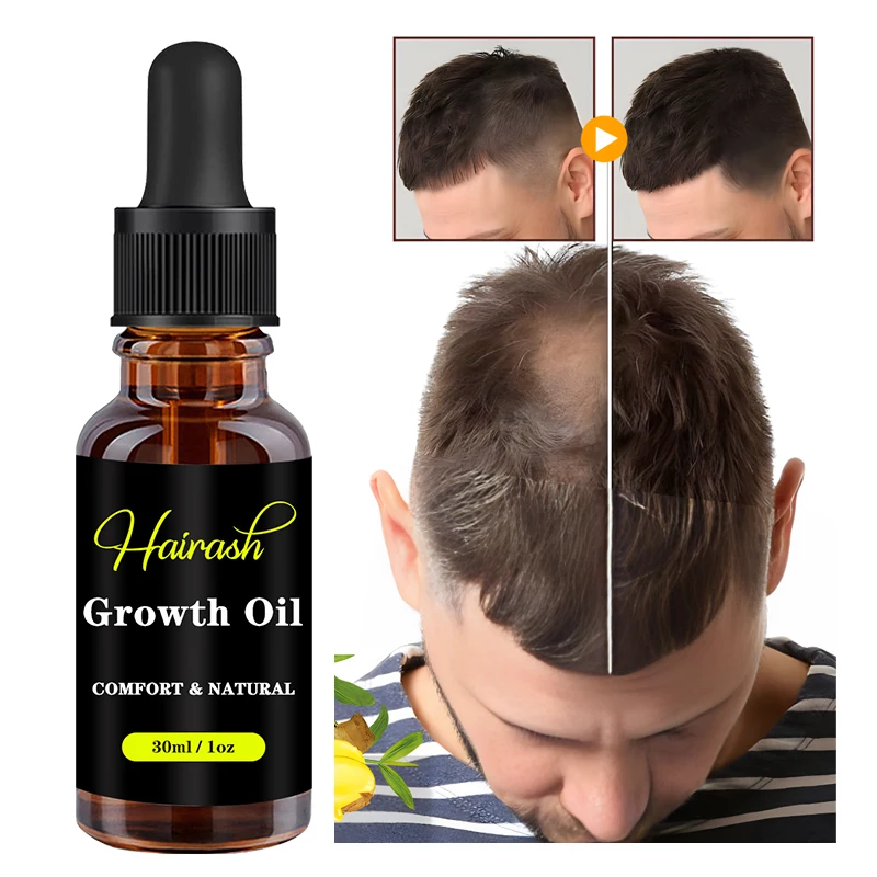 Óleo De Crescimento De Cabelo Para Homens E Mulheres, Tratamento De Perda De Cabelo, Soro De Óleo De Gengibre, Adultos