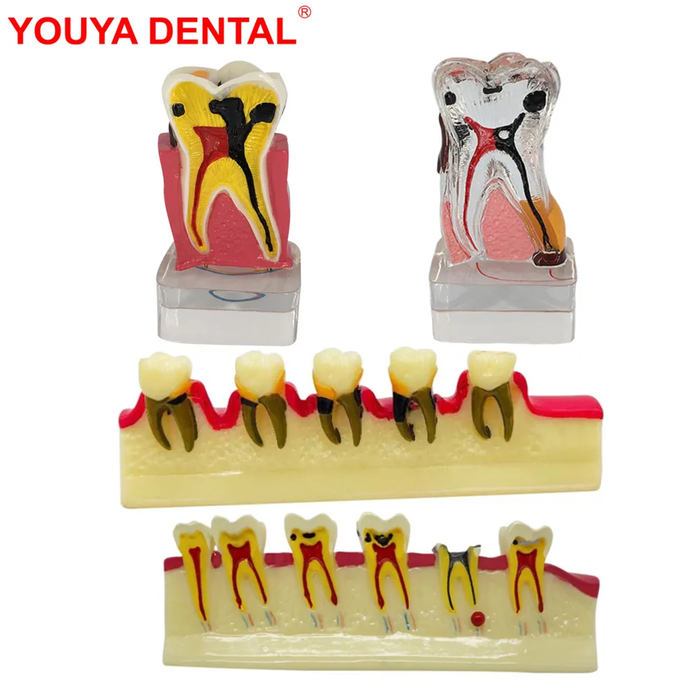 

Dental Teeth Model Periodontal Disease Model Dentistry Tooth Model Periodontitis For Studying Teaching Education Demonstration