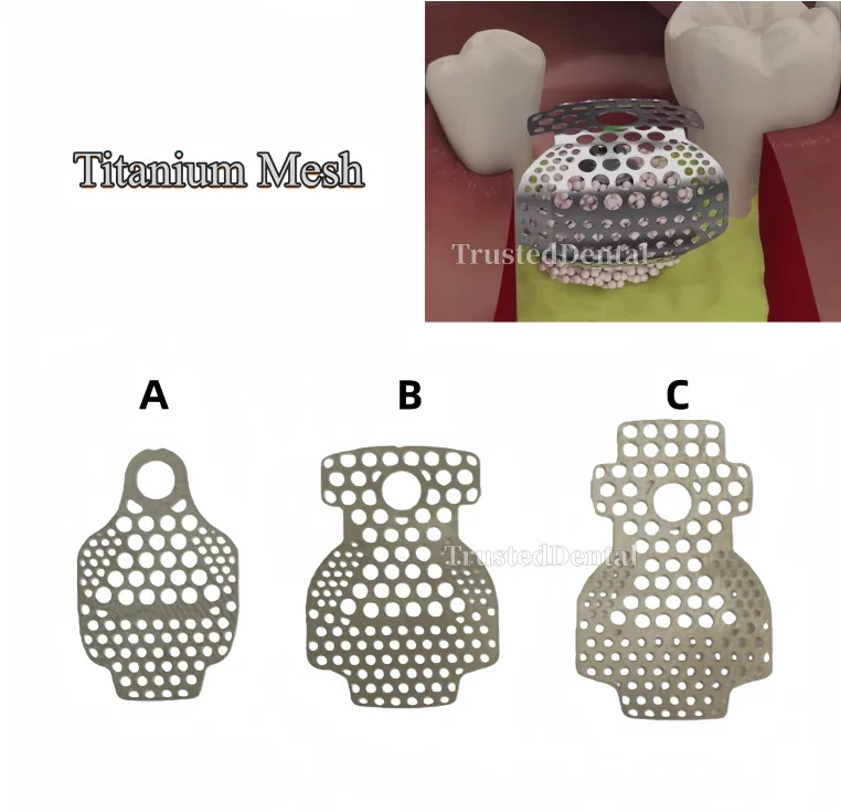 Dental GBR Titanium Mesh Bone Graft Dental Dish Membrane Plate Titanium Orthodontic Plates Flexible Grid