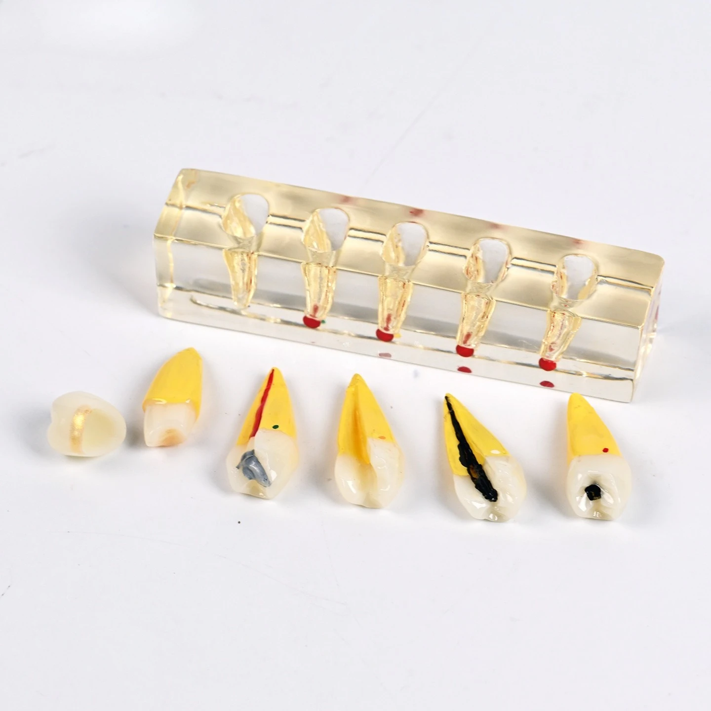 Dentals pathological treatment model dentals caries disease model