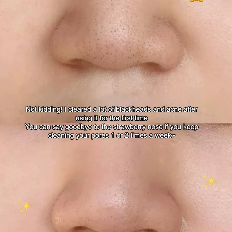 1 Stuks Facial Skin Scrubber Comedondrukker Met Cover Gezicht Spatel Peeling Diepe Reiniging Huidverzorging Tool