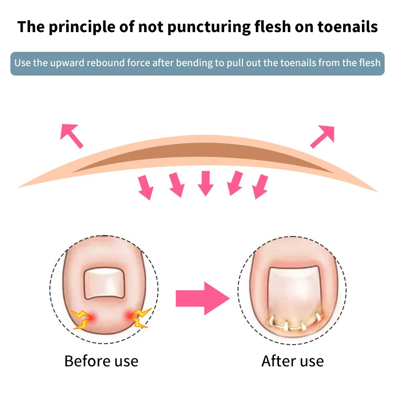 قطعة واحدة من جهاز تصحيح أظافر القدم الغارزة - مشبك تمليس مرن غير مرئي لمحاذاة أظافر القدم والعناية بالباديكير #6