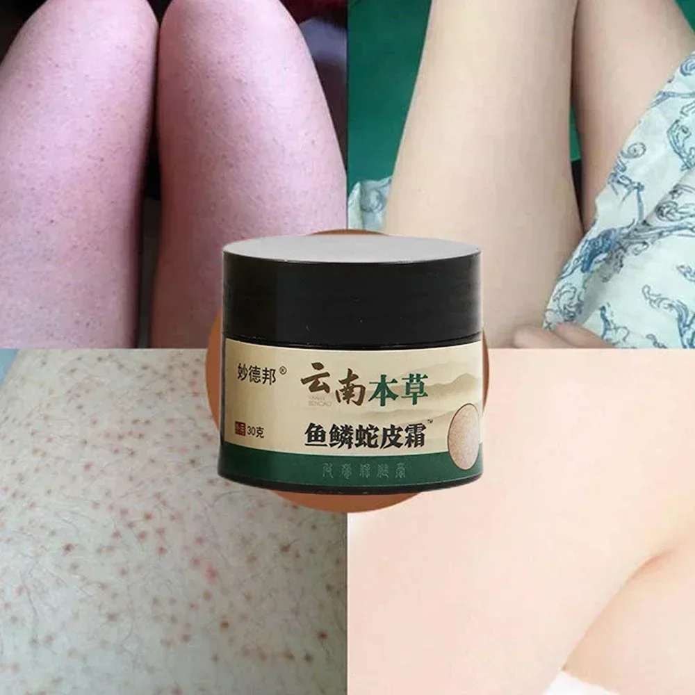 Curing Keratosis Pilaris Chicken Follicle Skin Repair Cream Body Dark Spot Remove Whiten Smooth Moisturize Skincare Body Lotion