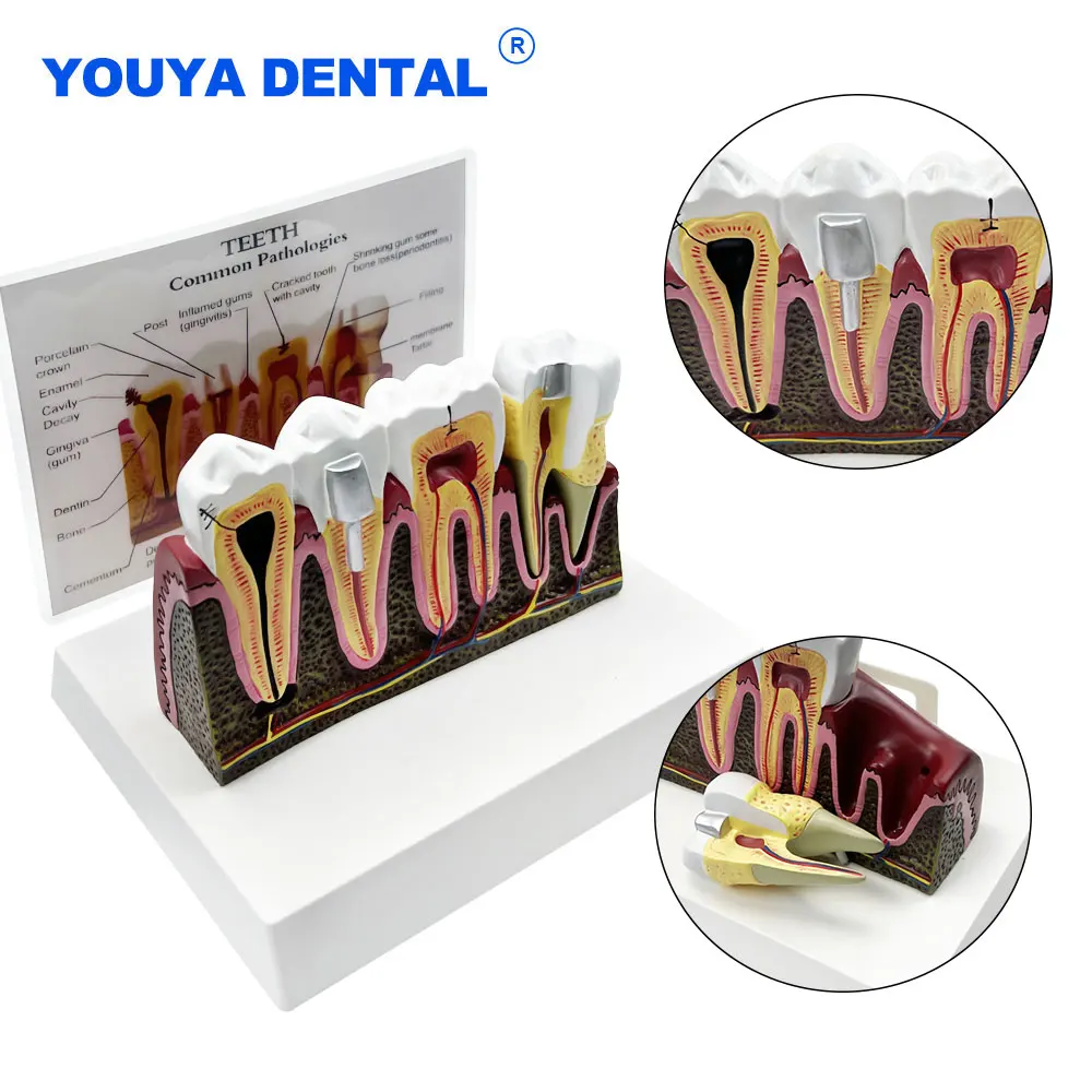 Dental Pathologies Anatomical Structure Model For Teaching Studying Root Canal Treatment Demonstration Dentist For Patient