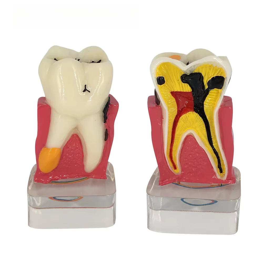 Dental Model Resin 4times Transparent Molar Anatomy Teeth Modeling With Nerves Medical Science Oral Dentist   Dentistry Products
