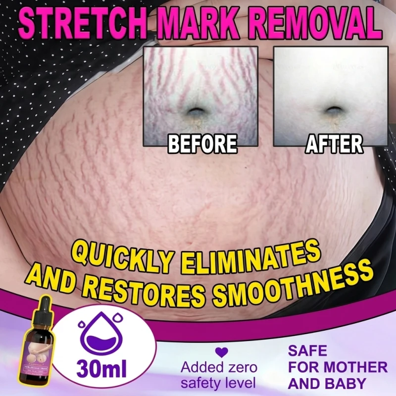Stubborn Maternity Blemish Destroyer Fast Belly Firming Liquid Rescue Shrink Loose Skin After Birth Deep Dermis Repair Oil Extreme Stretch Mark Minimizer Dark Spot Fader Smooth Tight Contour Treatment Clinical Postpartum Beauty Care Serum