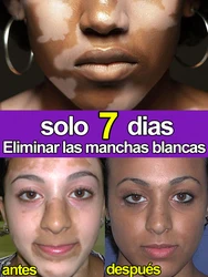 Crema de tratamiento del vitíligo para aliviar la eliminación de manchas blancas en la piel.