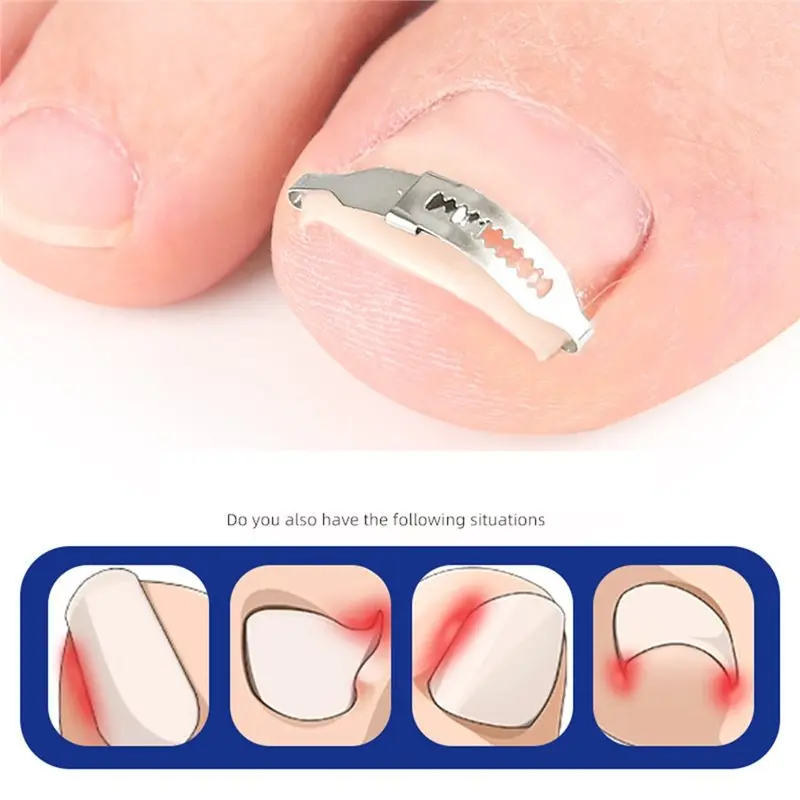 [NEWA66Z!】 Professional Ingrown Toenail Correction Corrector Tools Foot Care Tool For Pedicure Recovery Embedding Toe Nails