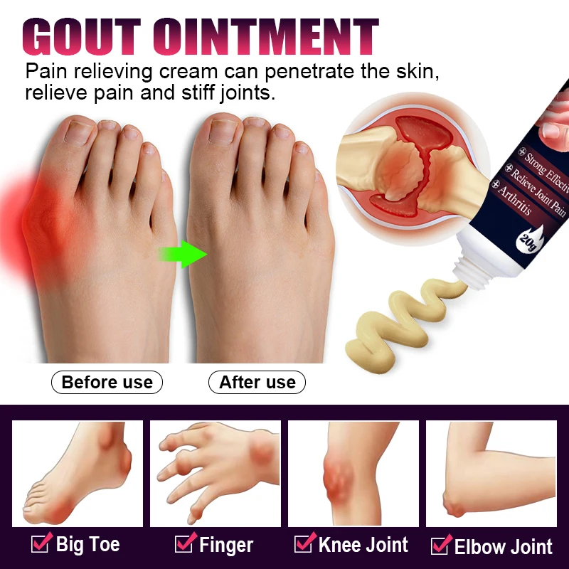 1Pcs Bunion Treatment Cream Gout Pain Relieve Joint Bone Toe Valgus Straightener Corrector Orthopedics Arthritis Herb Cream G043