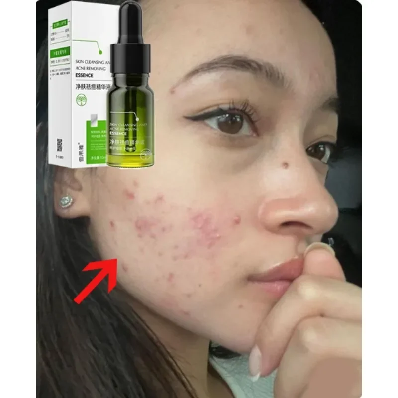 

Acne Treatment Face Cream Salicylic Acid Acne Scar Pimple Remover Whitening Oil Control Smoothing Facial Skin Care
