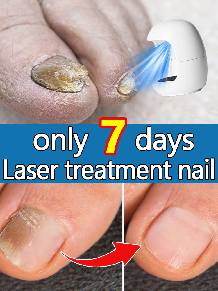 ERASE Onicomicosis FOREVER! Recurrencia ZERO NO daños en las uñas: ¡MATAR los hongos en 7 días, 99,3% tasa de SUCCESS!