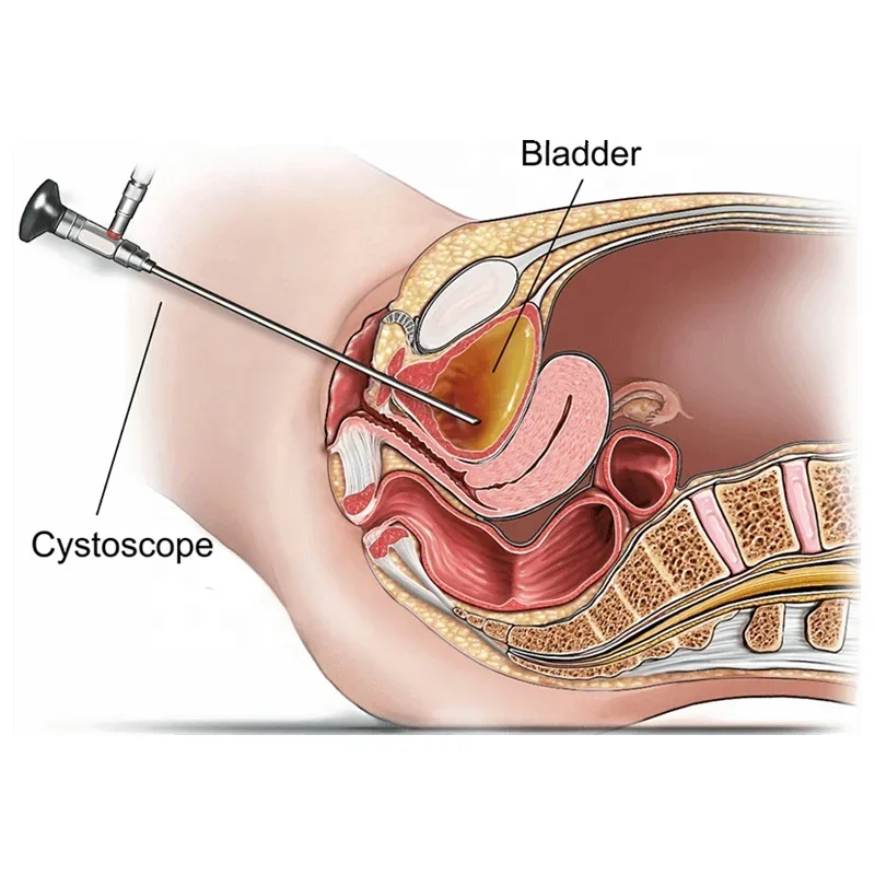 

endos/copes for pedia/tricss, Urolo/gys, Sur/gery Customizable 0, 30 degree 4mm, 2.7mm rigid