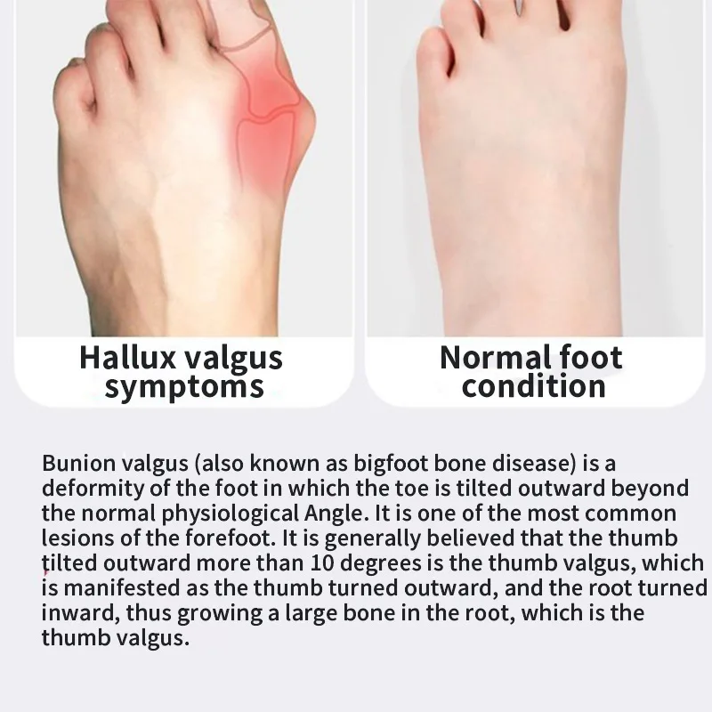 Elektrischer Hallux-Valgus-Korrektor, Zehenglätter mit TENS-Massage zur Schmerzlinderung, Fußpflege, orthopädisch – Detail 10
