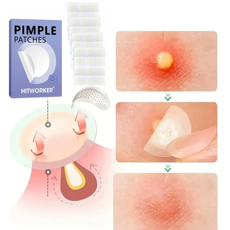 24pcs Acne Patches – Gentle Hydrocolloid Spot Covers, Waterproof & Dust-Free, Individually Wrapped, Absorbs Pimples