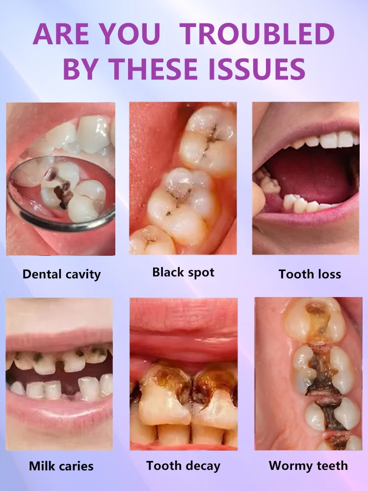 Decay tooth Cavities healing anti caries