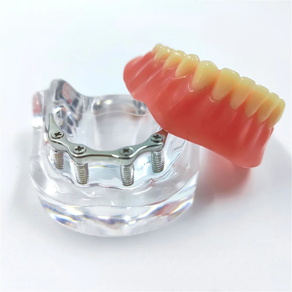 Dental Teeth Model With Implants Gold/Silver Bar Type Overdenture Restoration Treatment Typodont For Dentist Patient Teaching