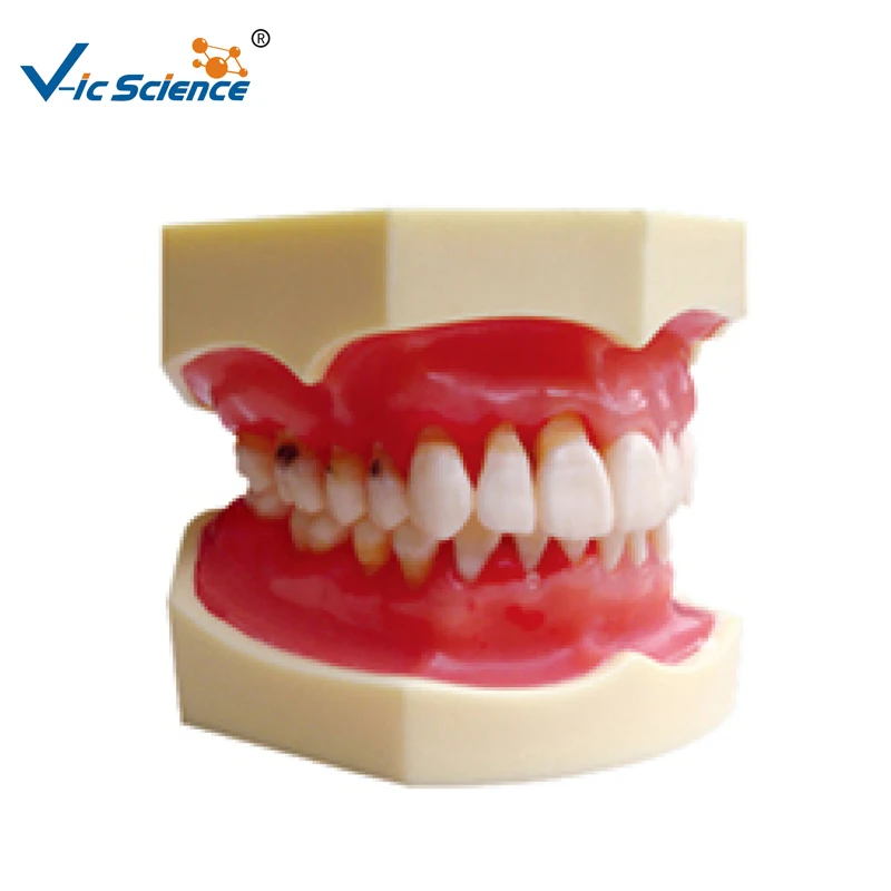 

Peridontal Disease Teeth Model Human Den-tal Model