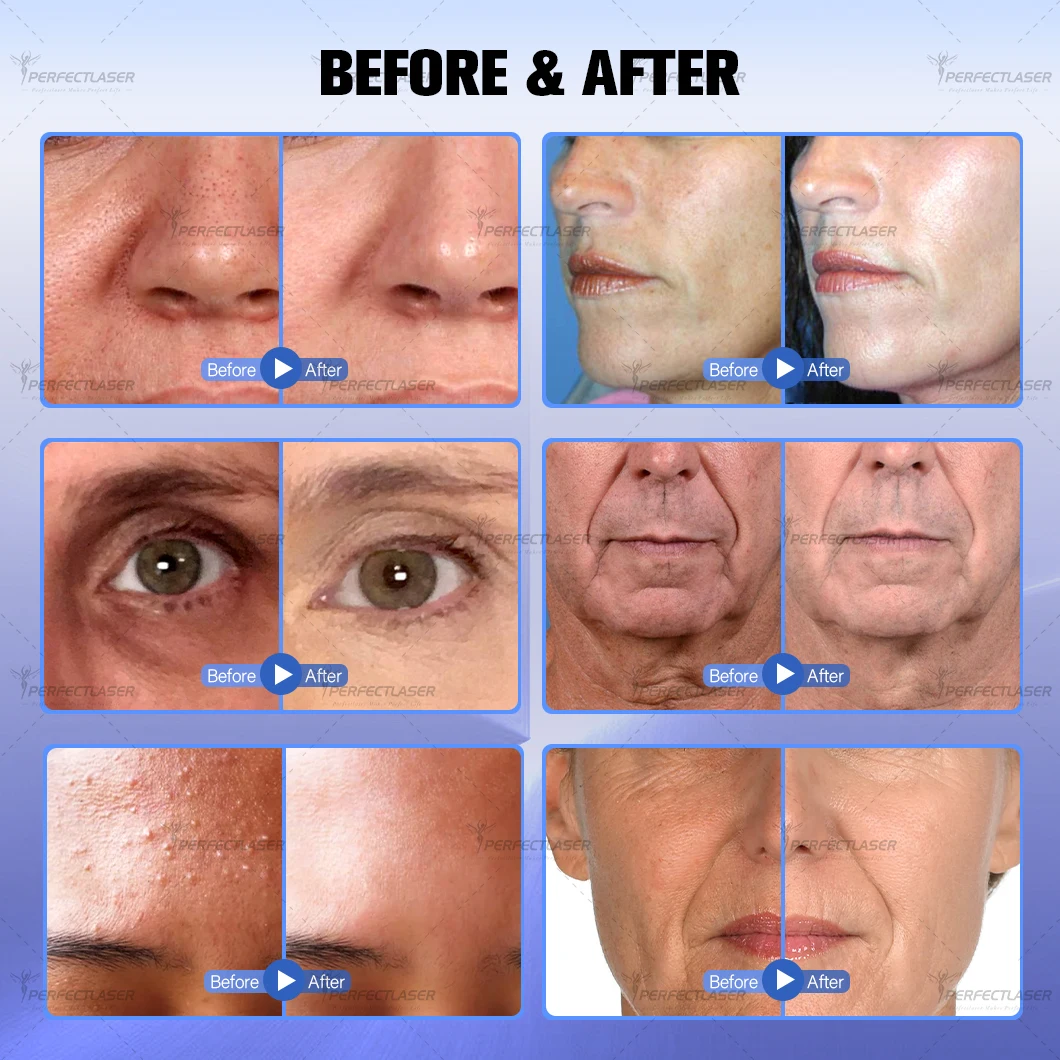 Machine Hydro Dermabrasion à oxygène 10 en 1, diamant, nettoyage en profondeur de la peau, rajeunissement du visage, eau, dispositif de soins de la peau du visage