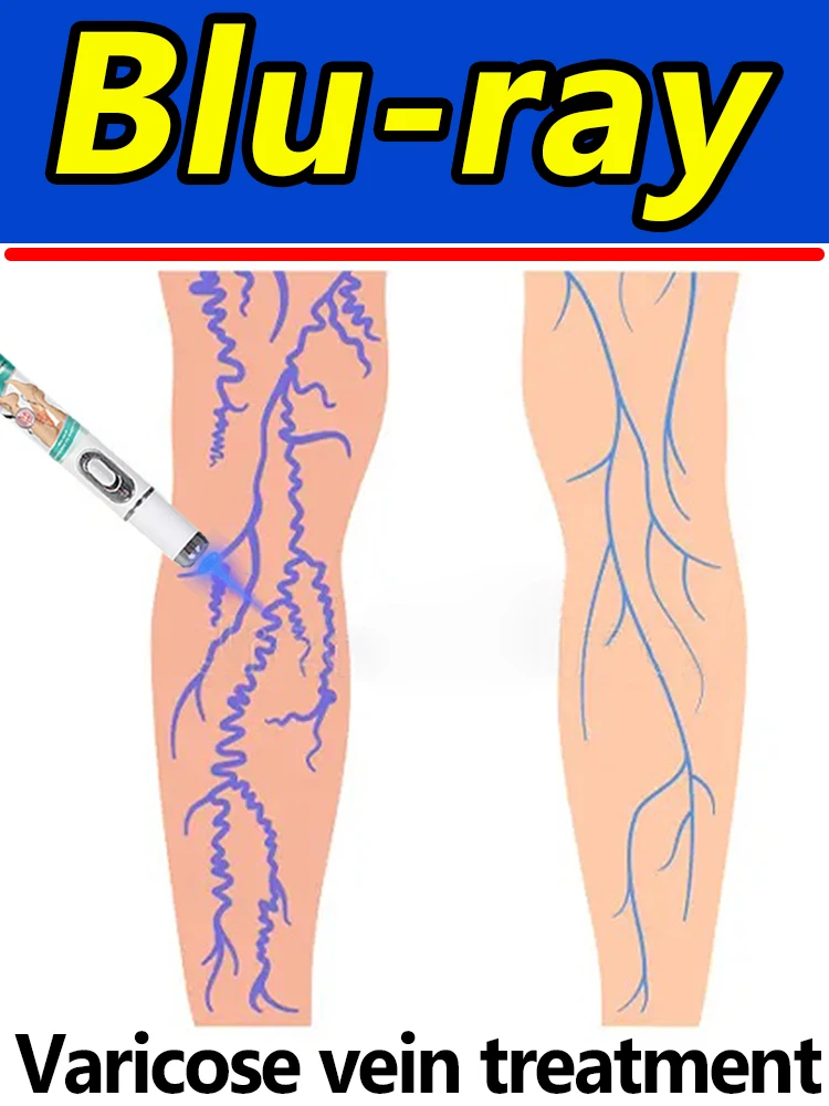 

GENERATION-2 LASER VANISH Varicose/Spider Veins