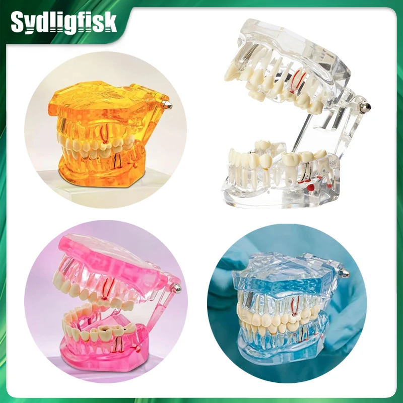 

Dental Teeth Model Implant Restoration Bridge Teaching Study Tooth Disease Removable Model Dentist Education Demonstration Model