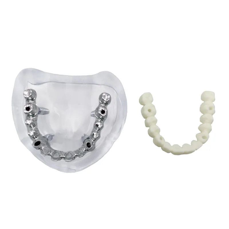 Dental Model Implant Restoration Model Maxillary Removable Overdenture Model With 4 Implants Dentist Students Education Model