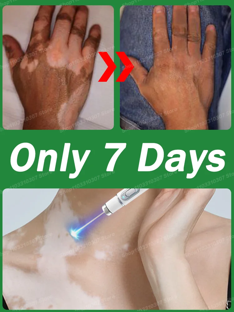 Efficient Quickly Improve Vitiligo