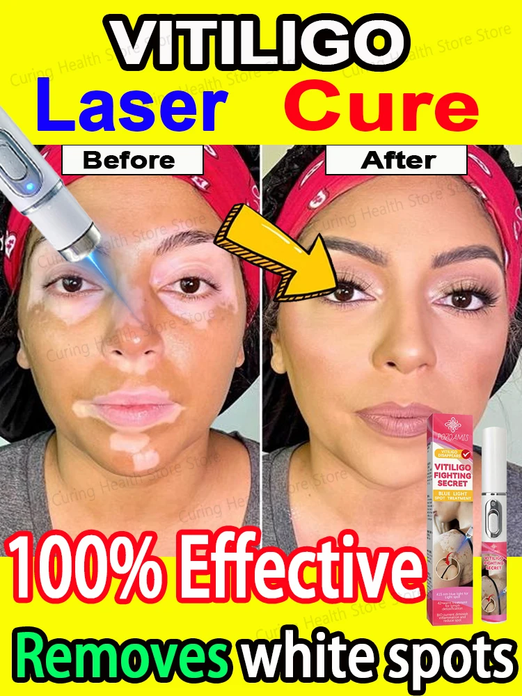 laser vitiligo