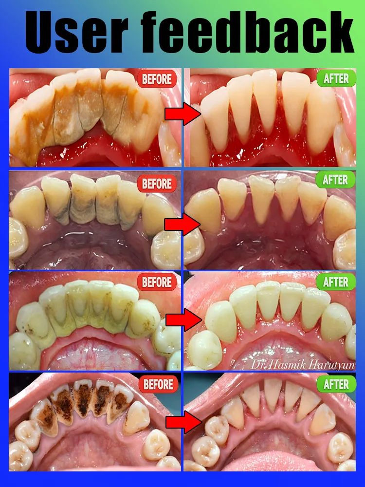 Teeth Tartar Removal  Dental Calculus Toothpaste