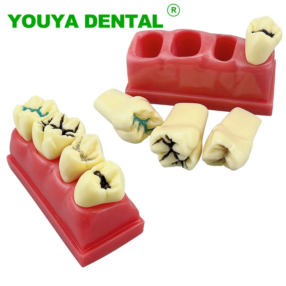 Dental Study Model 4 Times Pit And Fissure Sealing Treatment Teeth Model Dentist Demonstration Model Dentistry Tool Laboratory