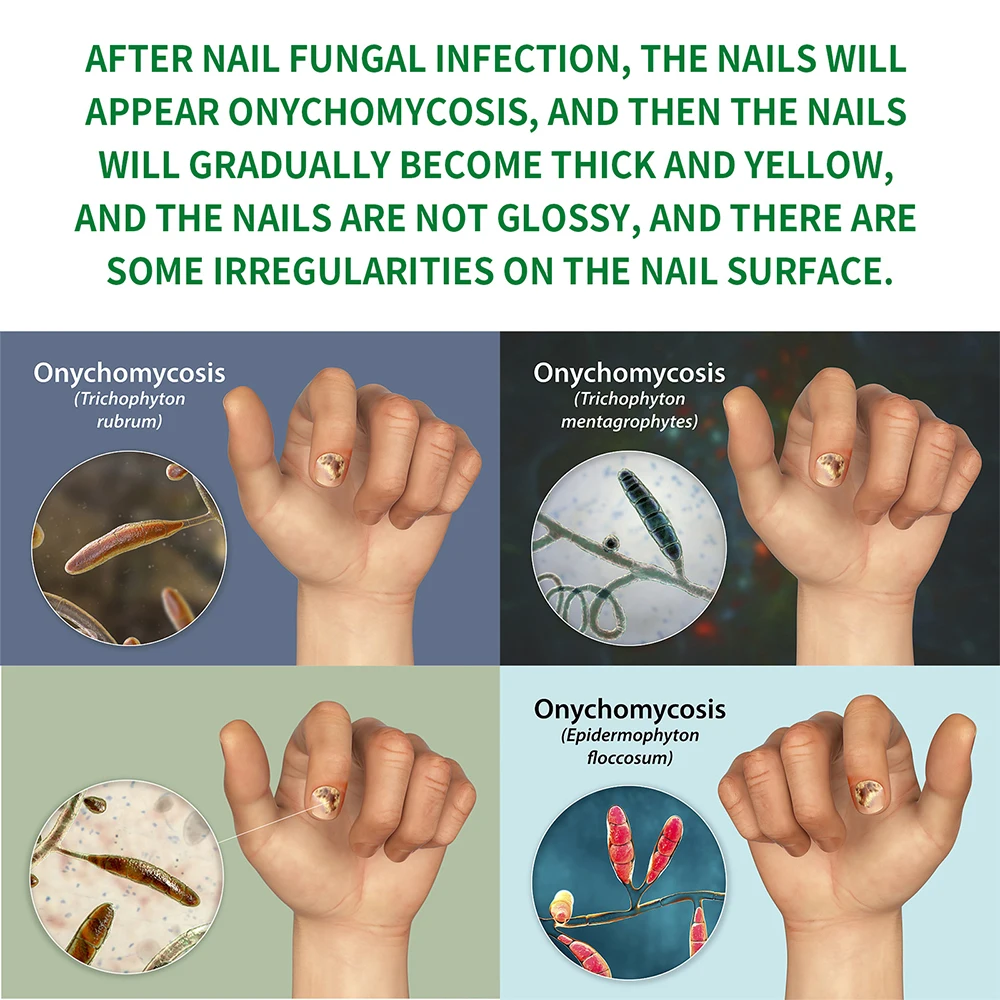 Nail Fungal Treatment Device 7 Days Repair Oil Foot Toe Essence Anti Infection Paronychia Ginger Onychomycosis Gel Care Products