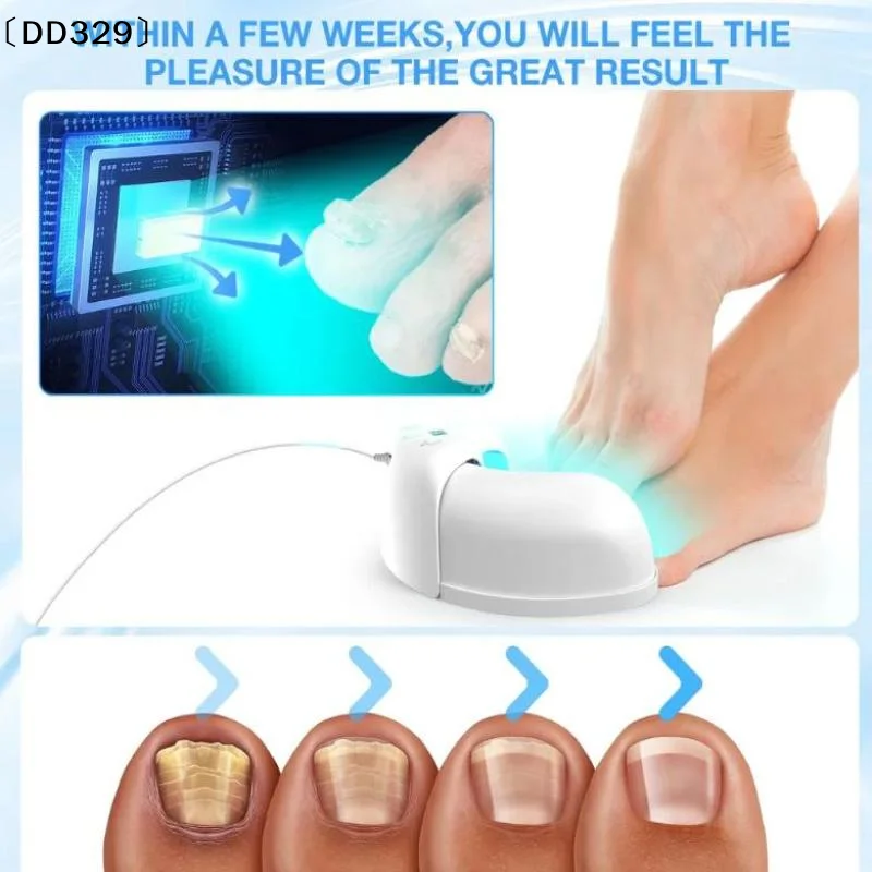 

Лазерный аппарат для лечения грибка ногтей: восстановление ногтей на ногах и руках, противогрибковое лечение, от паронихии, онихомикоза, вросших ногтей 〔DD329〕