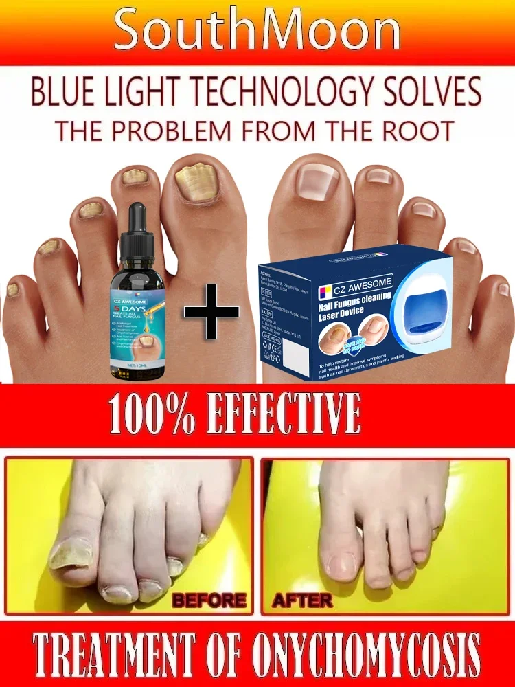 Fungal Nail Laser Onychomycosis Fungus Nails Repair Fast