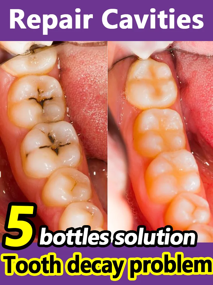 Tooth decay Repair Repairing Cavities Protecting Anti Caries