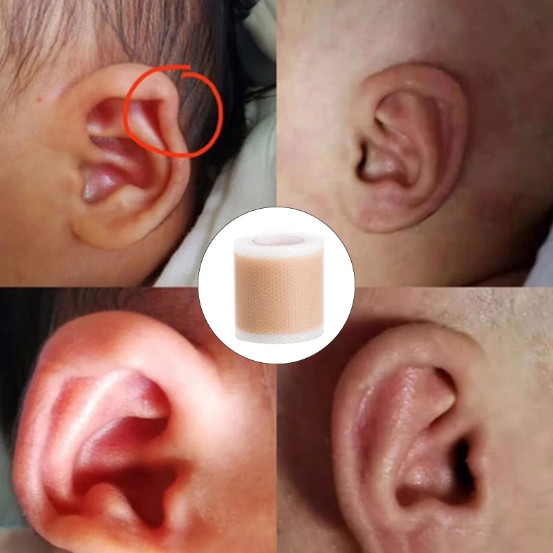 Baby Ear Corrector Infant Protruding Ears Correction 5 x 100cm Silicone Kids Ear Aesthetic Correctors Patch Sticker