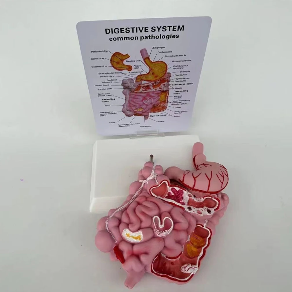 Adult Large Intestinal Pathology Model Human Digestive System Anatomy Model Medical Teaching Tools Gastrointestinal Lesions