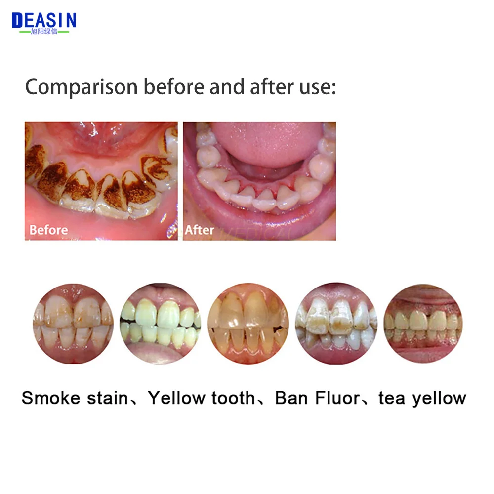 Narzędzia stomatologiczne materiały profia powietrzna jednostka wybielająca polerka do zębów Spary stomatologia Odontologia stosowanie maszyna do