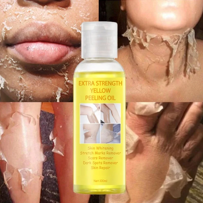 Óleo de Peeling Amarelo Super Força para Pele Negra, óleo clareador forte, removedor de pele, óleo de peeling amarelo clareador africano