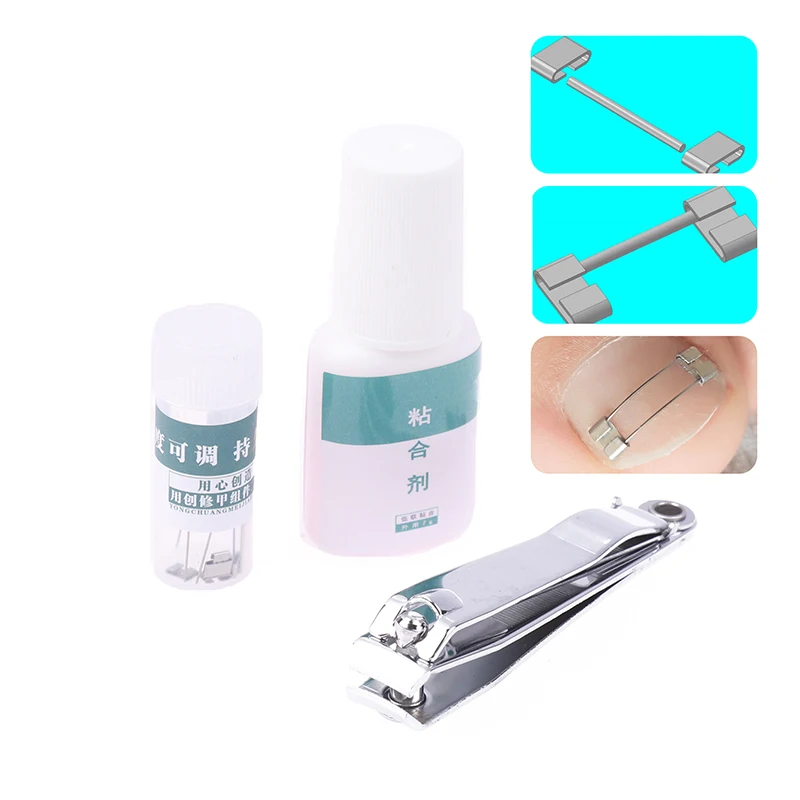 Ingegroeide Teennagel Correctietools Professionele Behandeling Herstellen Insluiting Teennagel Apparaat Pedicure Radiologie Rechttrekken Teen Gereedschap