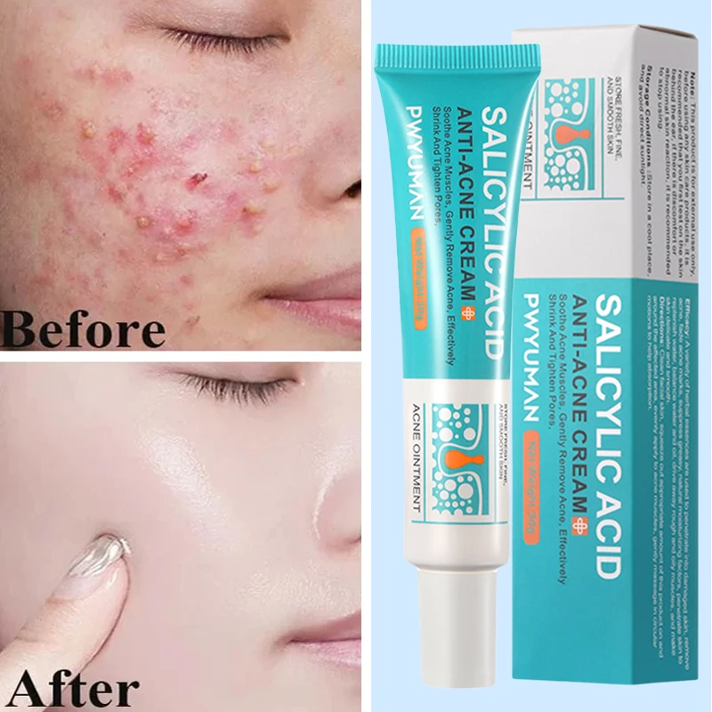 

Salicylic Acid Acne Treatment Cream Repair Pimple Spots Deep Cleaning Pore Shrinking Anti-acne Oil Control Moisturizer Skin Care