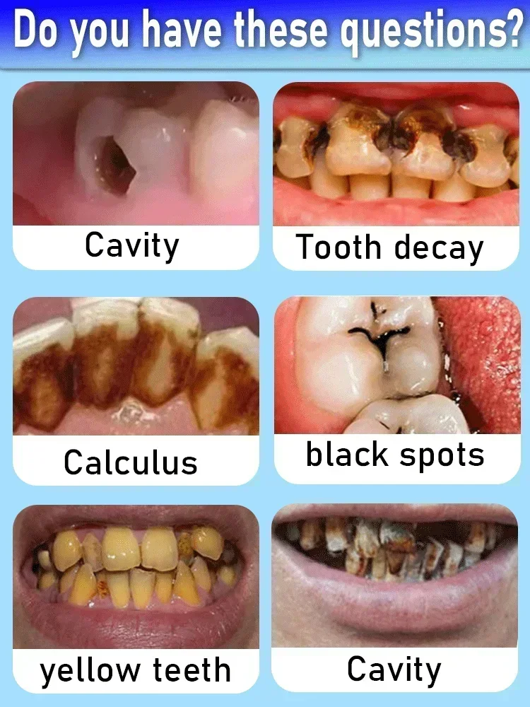 Effective Teeth Whitening Tooth decay repair  Calculus Plaque Periodontitis Remove Cavities